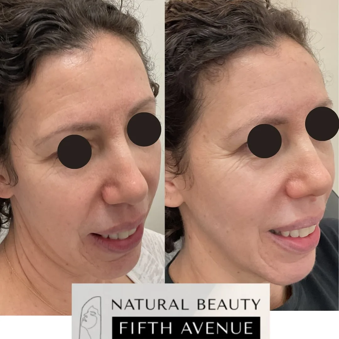 RF Microneedling with PRP Case 4 before and after