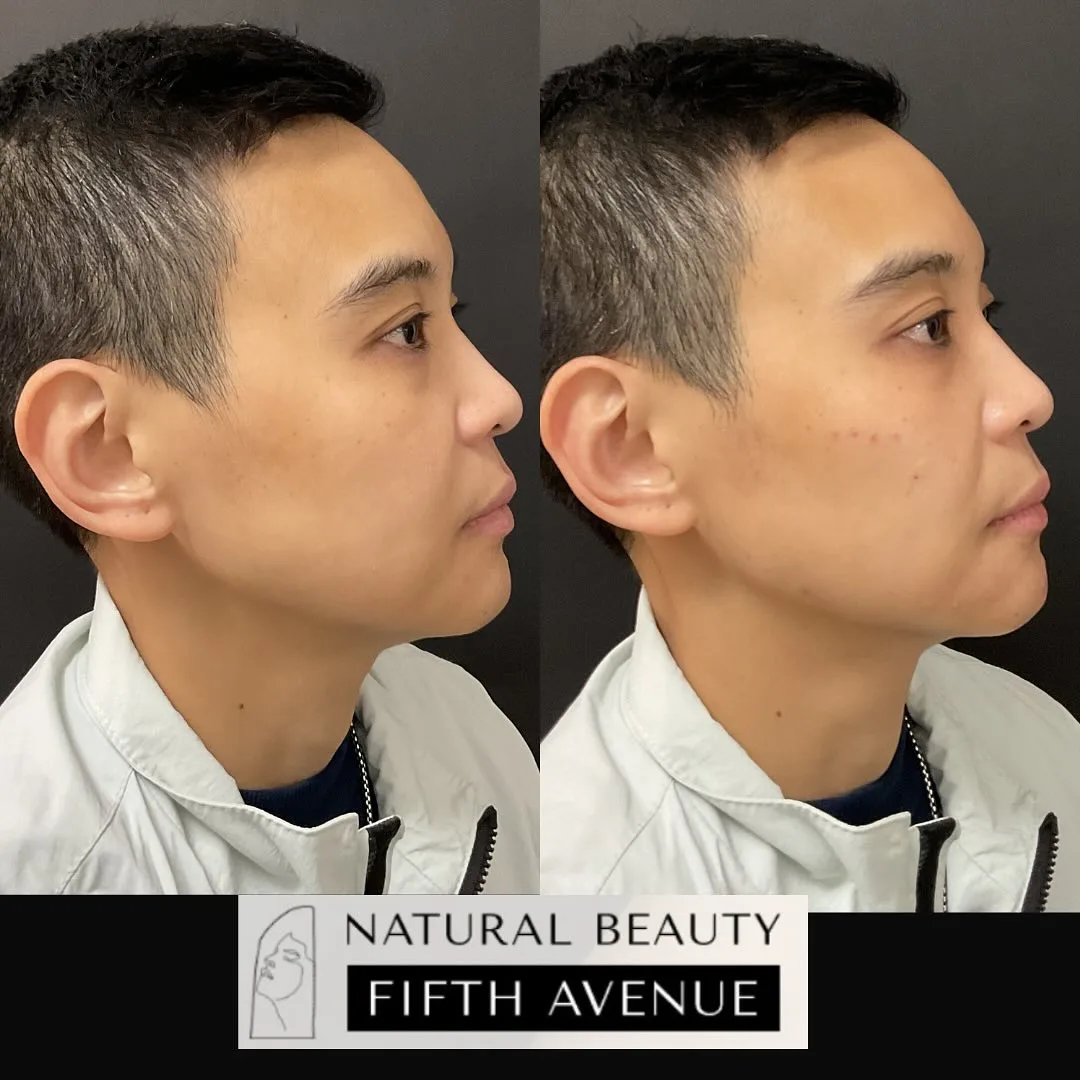 Dermal Filler Case 7 before and after at Natural Beauty NYC (3 of 4)