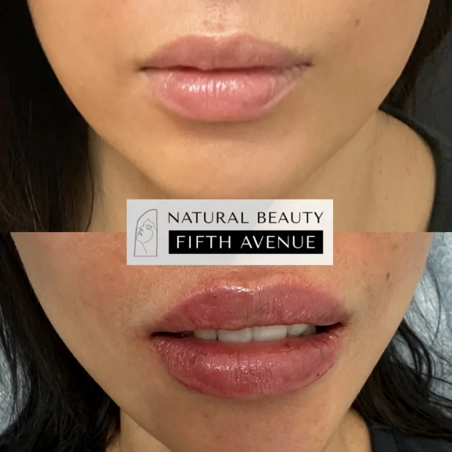 Lip Filler before and after