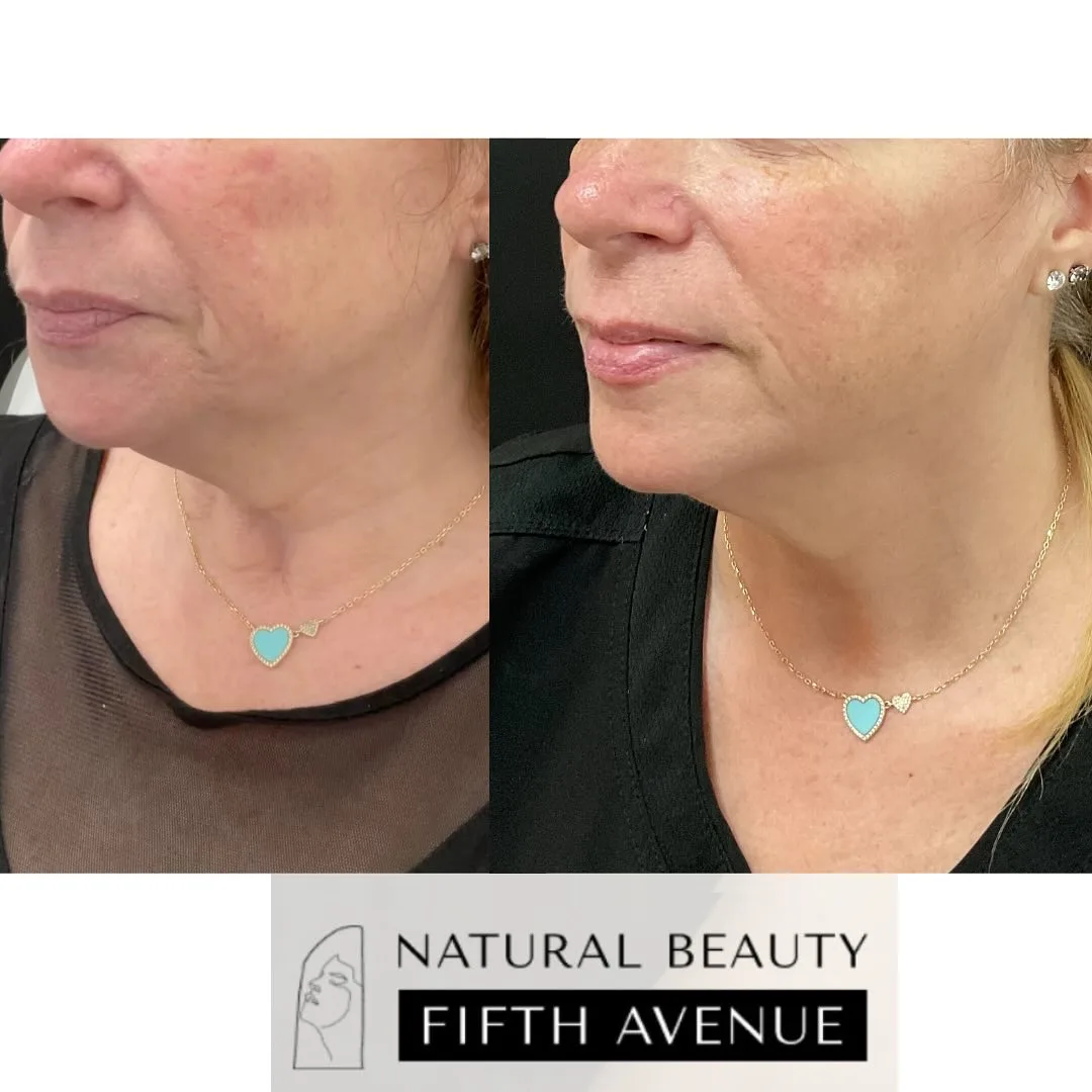 Nefertiti Lift Case 2 before and after