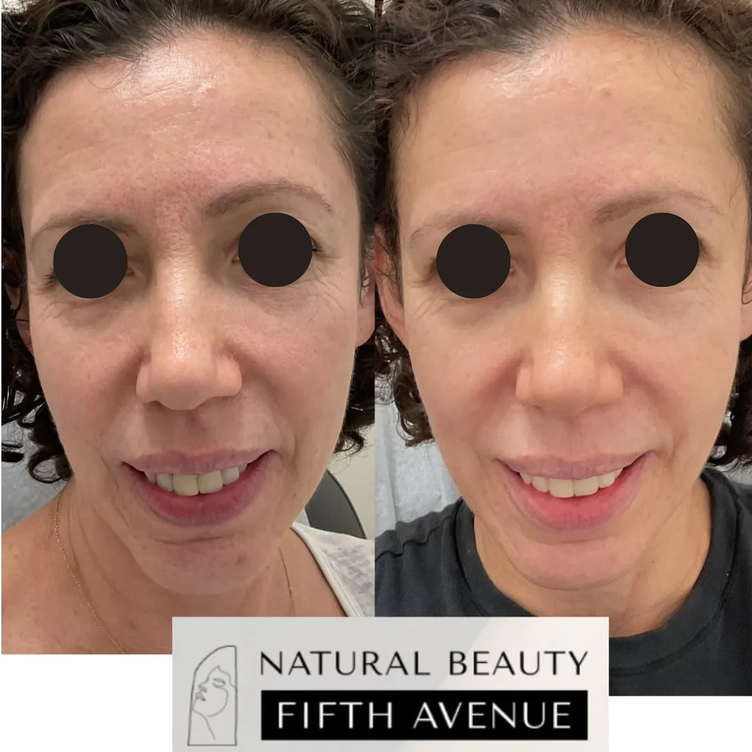 RF Microneedling with PRP Case 4 before and after at Natural Beauty NYC (2 of 3)