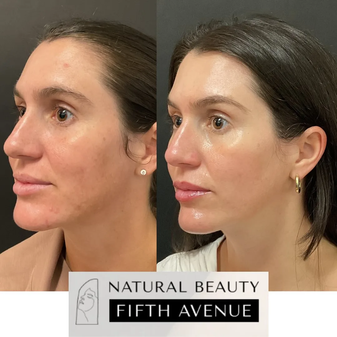 Skincare and Oral Medication before and after at Natural Beauty NYC (4 of 5)