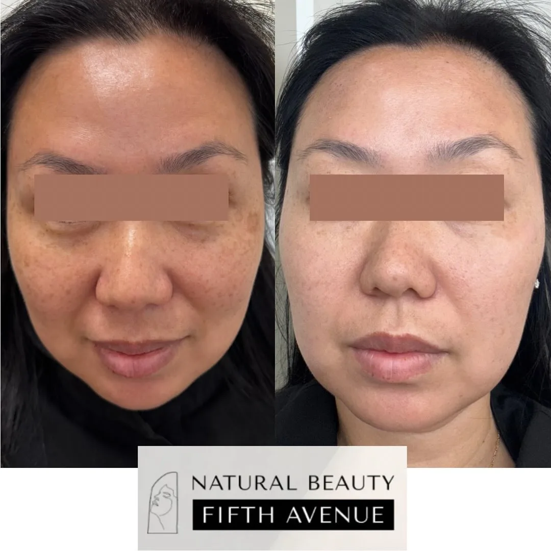 IPL Case 3 before and after at Natural Beauty NYC (3 of 3)