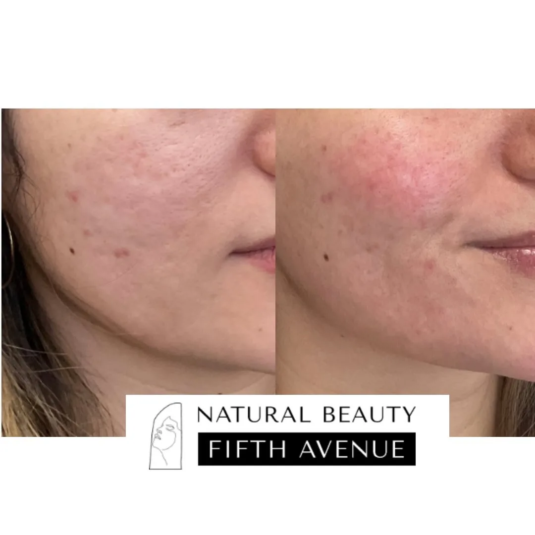 RF Microneedling + Subcision + Biostimulatory Injections before and after at Natural Beauty NYC (3 of 3)