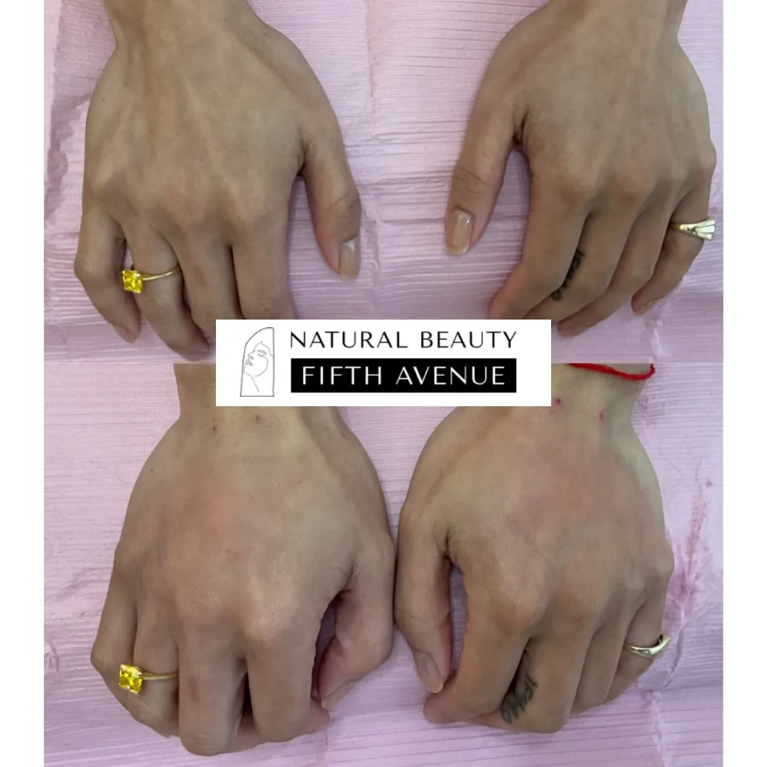 Radiesse Case 1 before and after