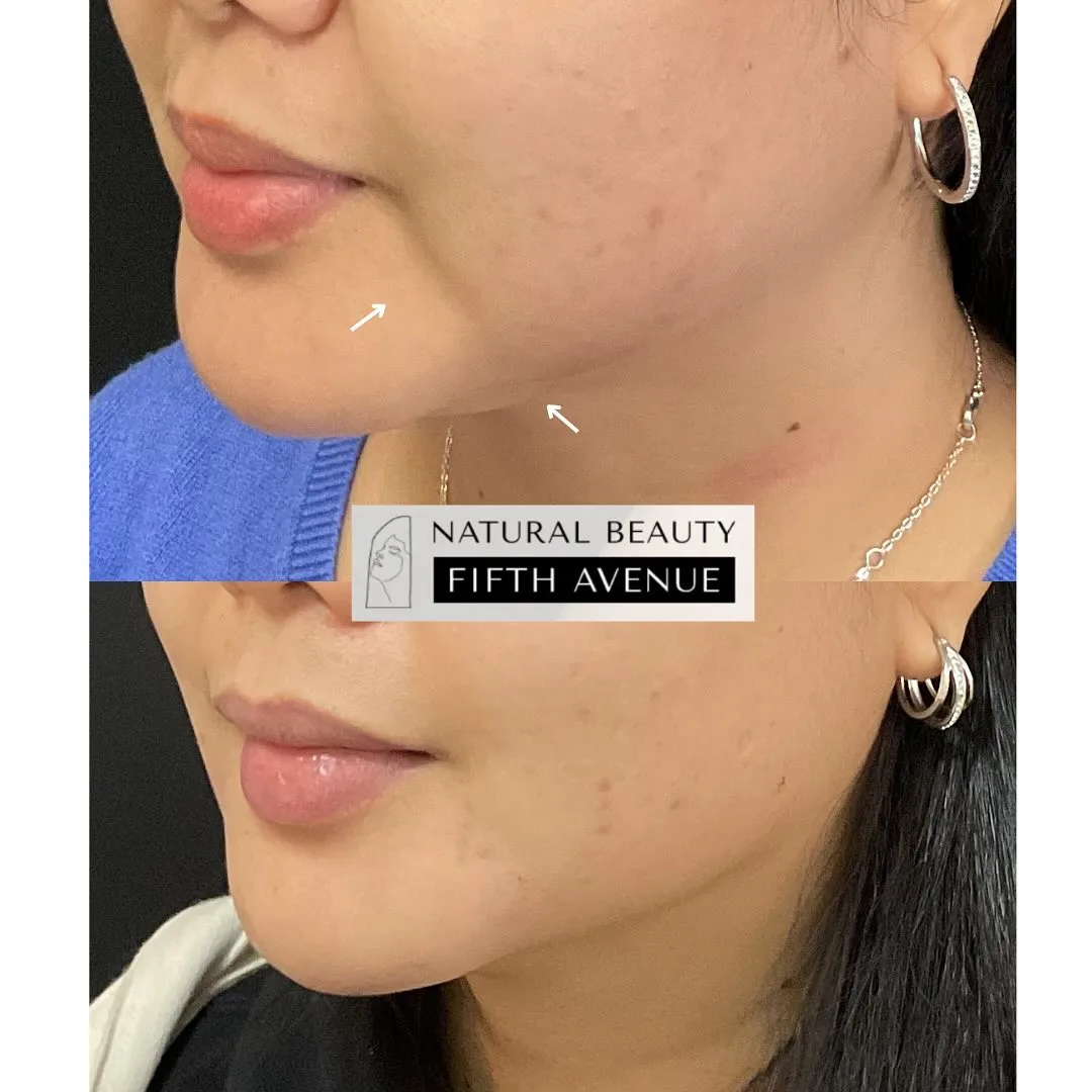 Hyaluronic Acid Fillers before and after at Natural Beauty NYC (2 of 3)