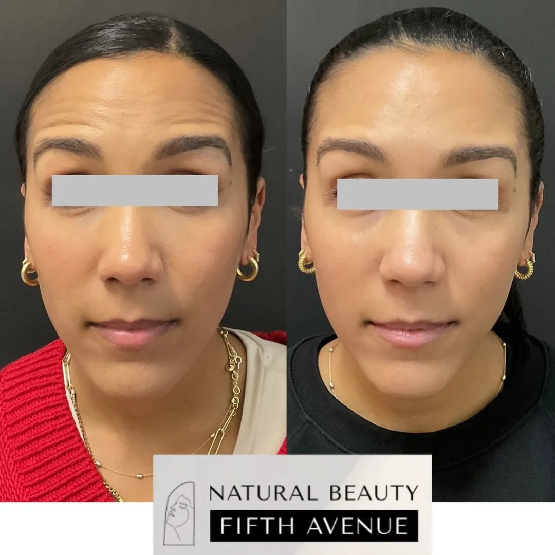 Dermal Filler Case 6 before and after