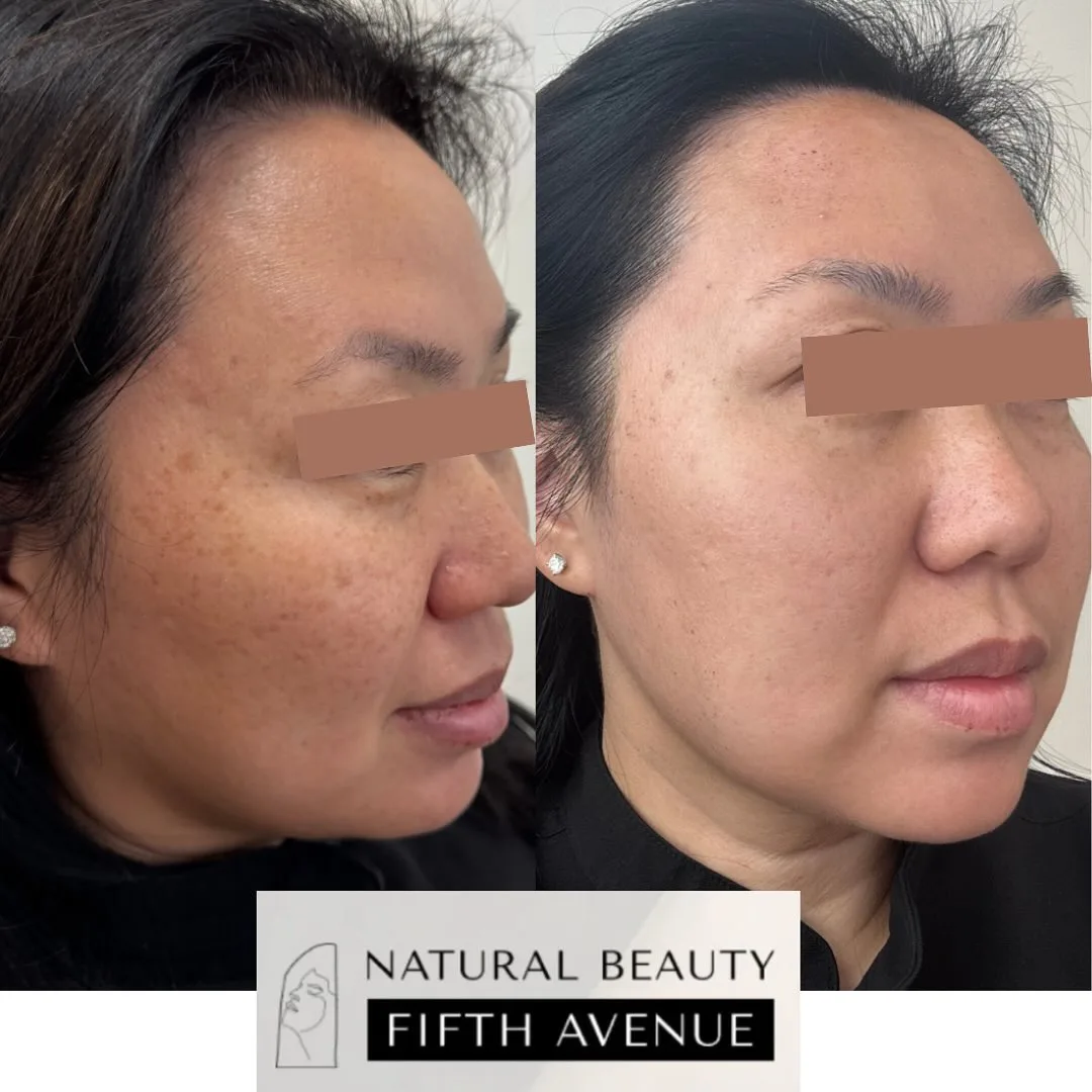 IPL Case 3 before and after