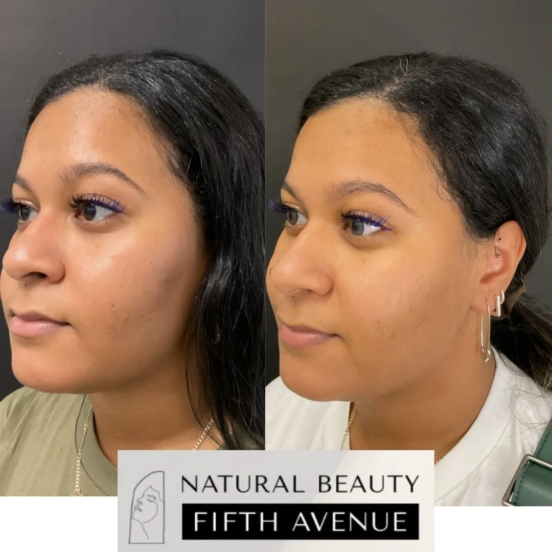 Chemical Peel Case 3 before and after