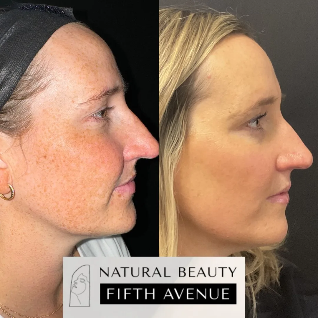 Skin Care after the procedure before and after at Natural Beauty NYC (3 of 5)