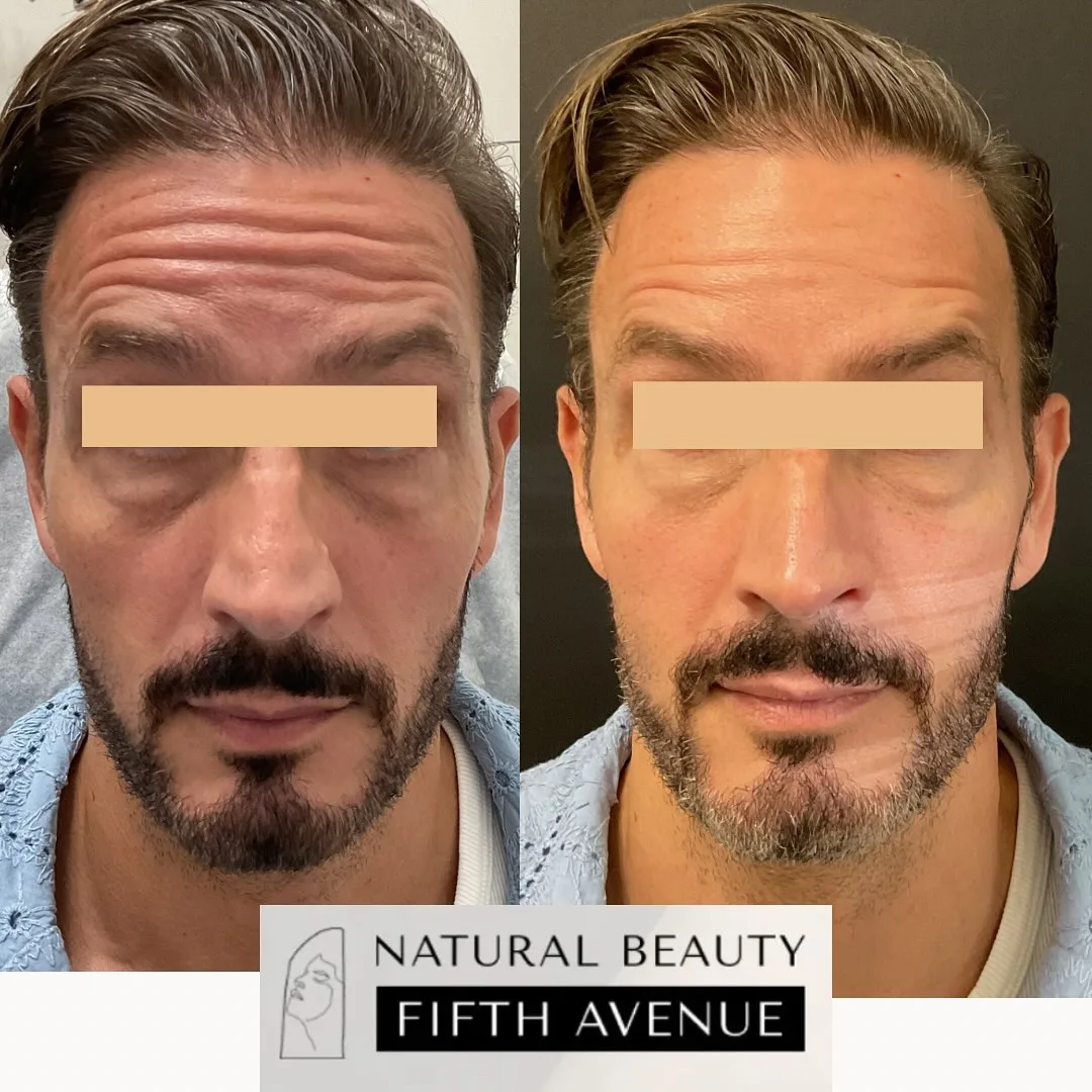 Neurotoxin Case 3 before and after at Natural Beauty NYC (3 of 3)