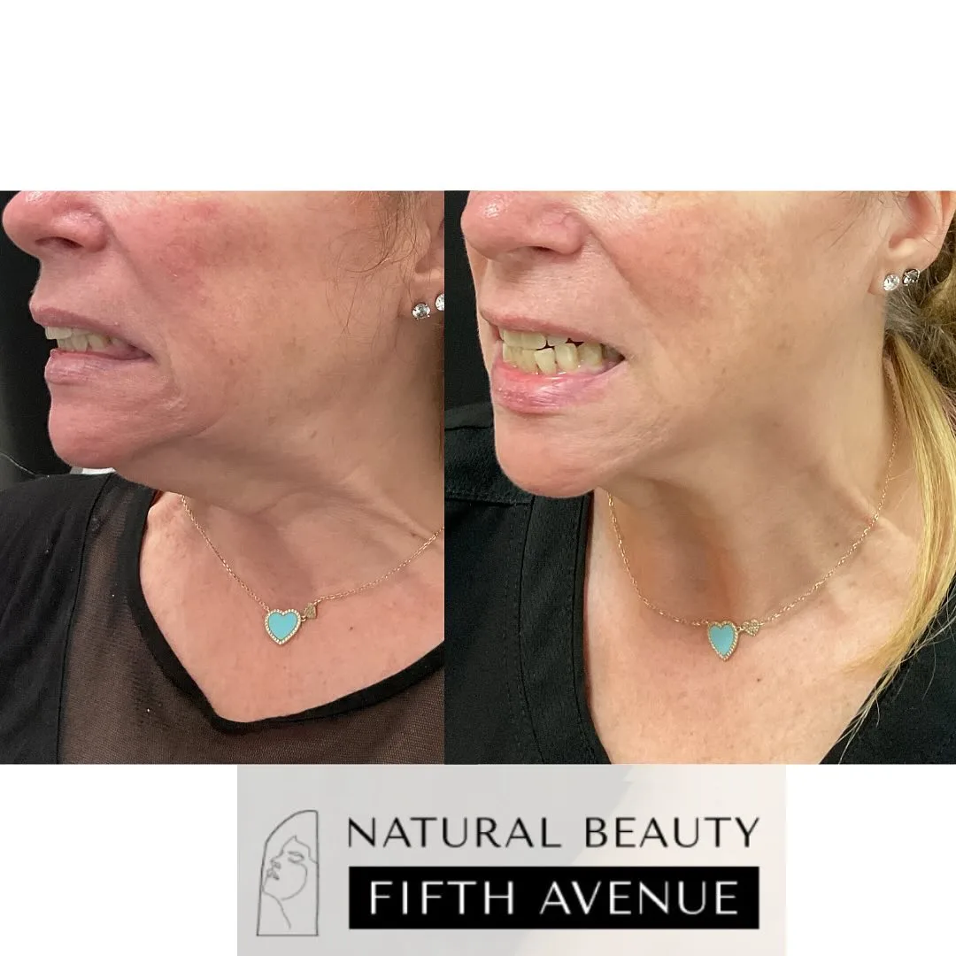 Nefertiti Lift Case 2 before and after at Natural Beauty NYC (3 of 4)