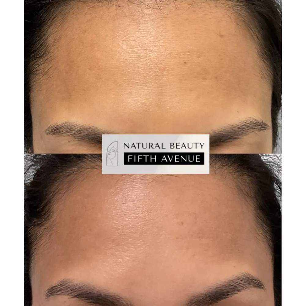 RF Microneedling with PRP Case 2 before and after
