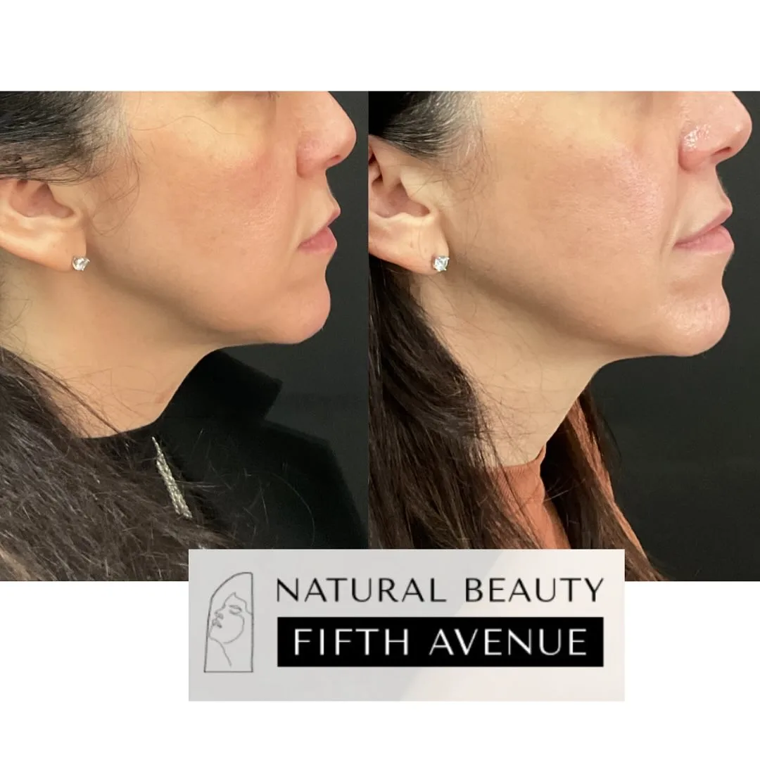 Sculptra Case 3 before and after