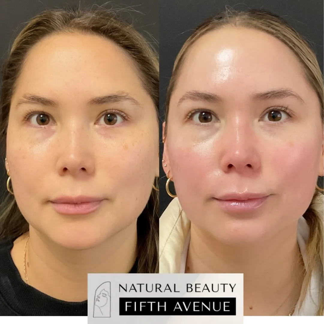 IPL , Chemical Peels before and after at Natural Beauty NYC (2 of 2)