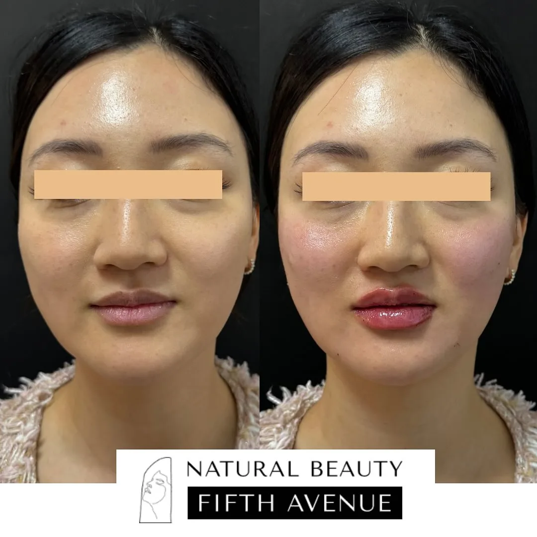 Dermal Fillers Case 4 before and after at Natural Beauty NYC (3 of 3)