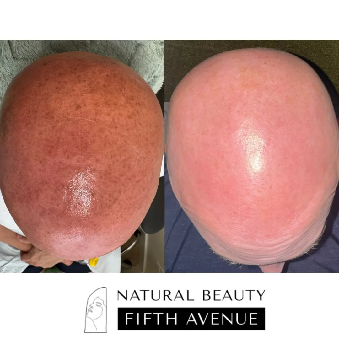 IPL with Frax before and after
