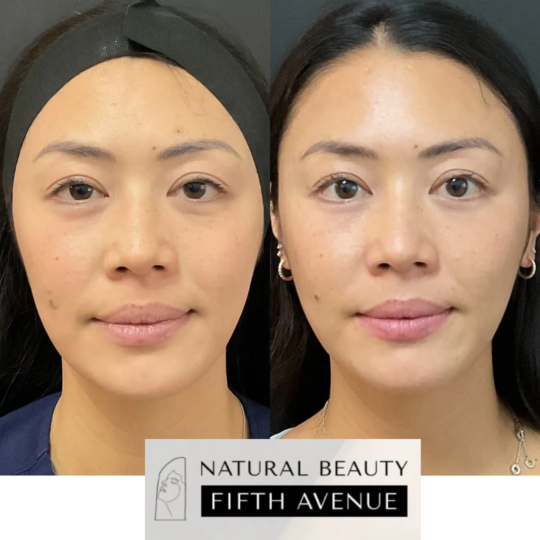 RF Microneedling with PRP Case 1 before and after