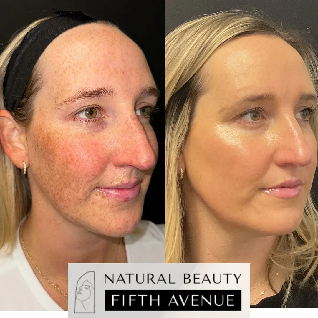Skin Care after the procedure before and after at Natural Beauty NYC (2 of 5)