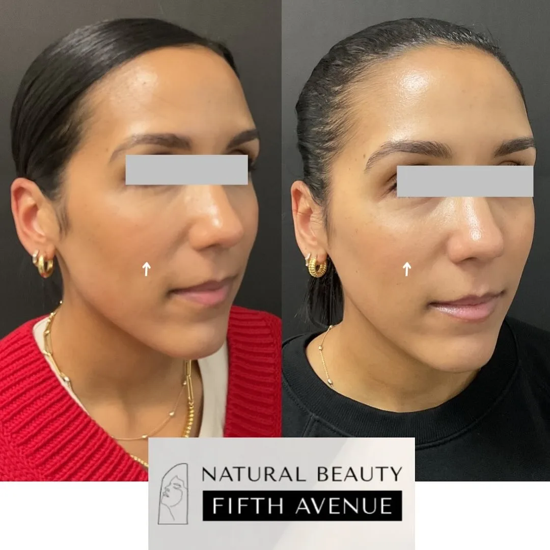 Dermal Filler Case 6 before and after at Natural Beauty NYC (3 of 4)