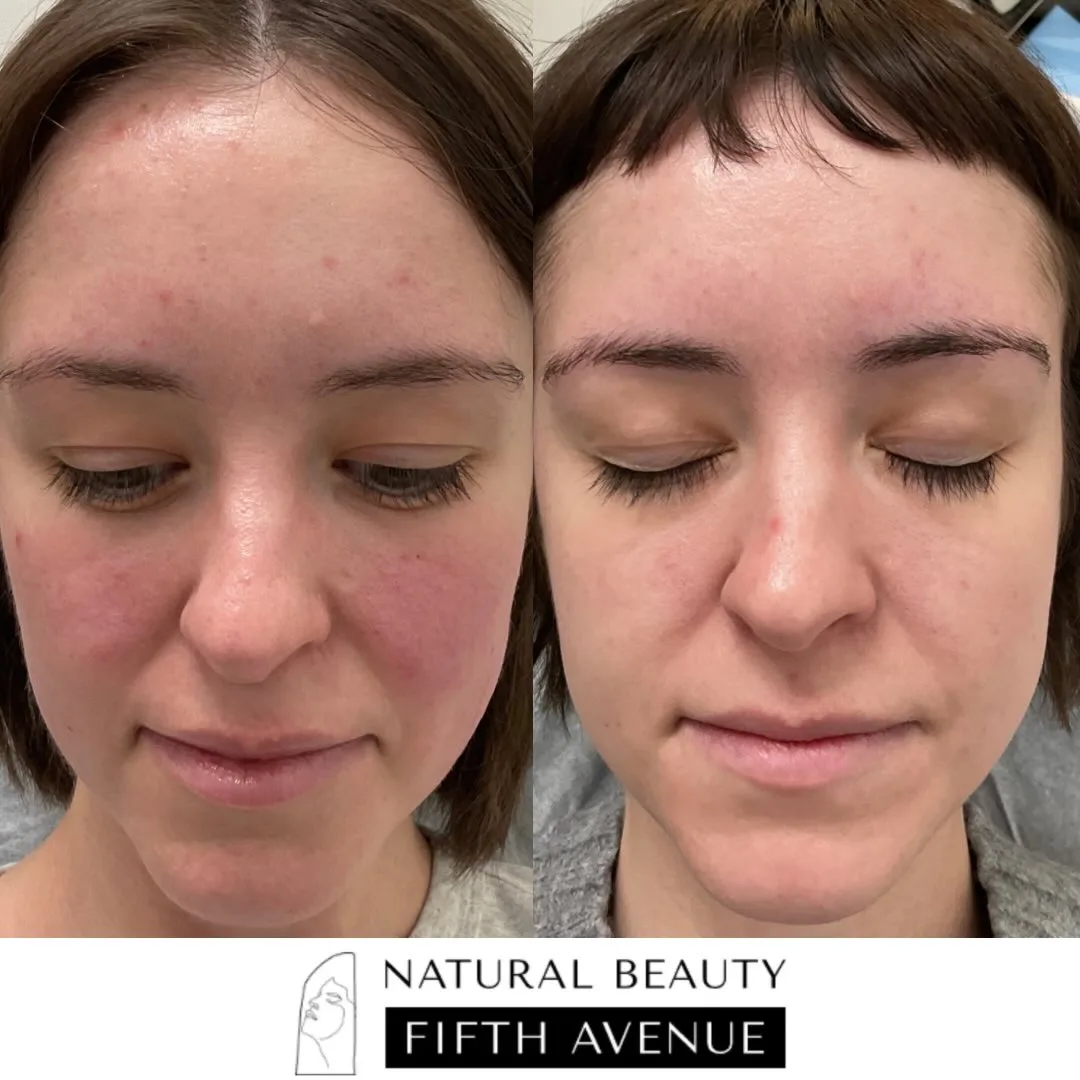 IPL Case 4 before and after