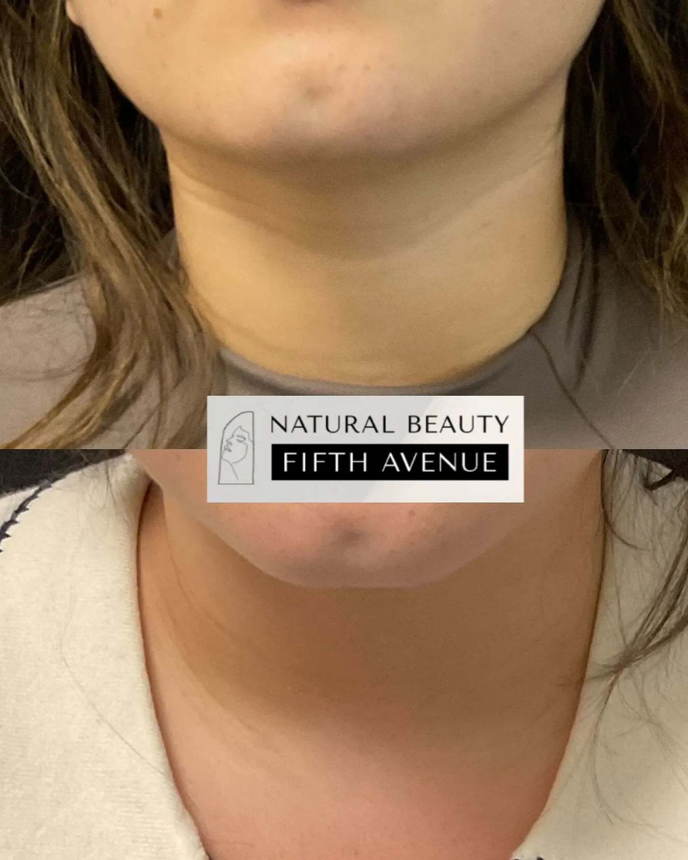 Filler and RF Microneedling before and after