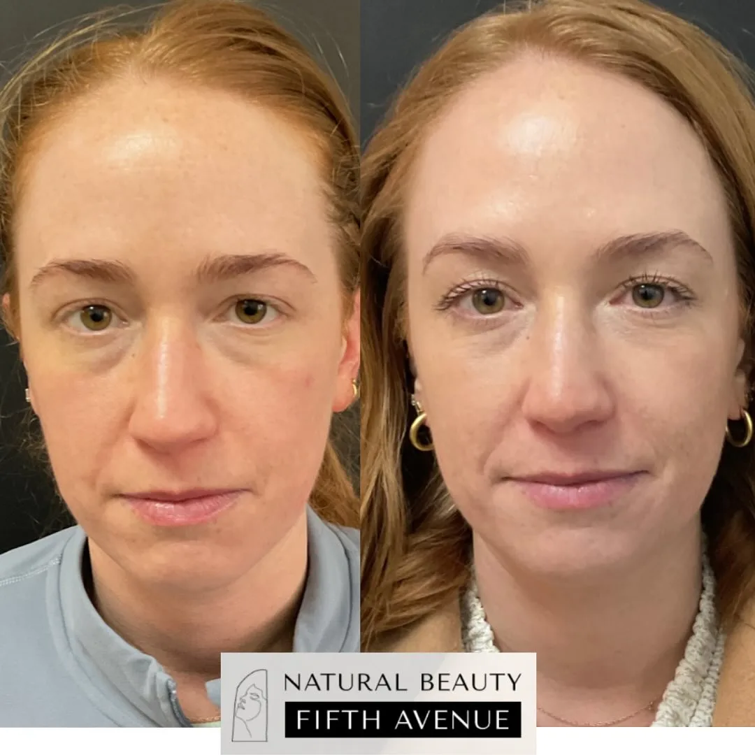 Brow Lift Case 1 before and after