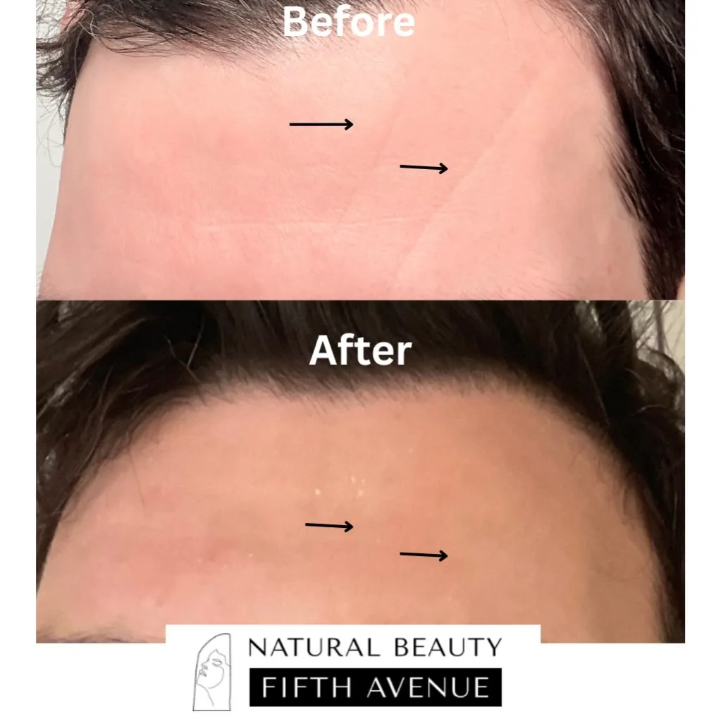 Neuromodulators, PRP ,RF Microneedling, Skincare before and after