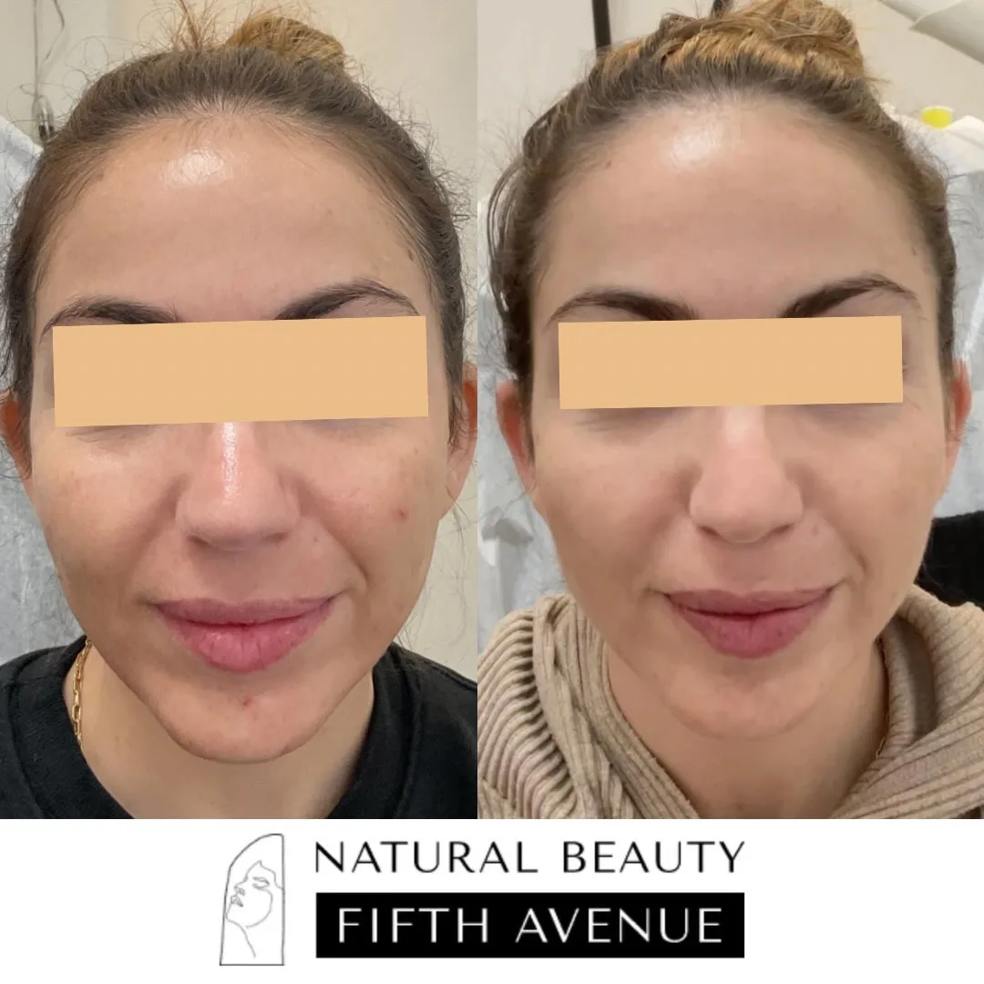 Radiesse Case 3 before and after at Natural Beauty NYC (3 of 3)