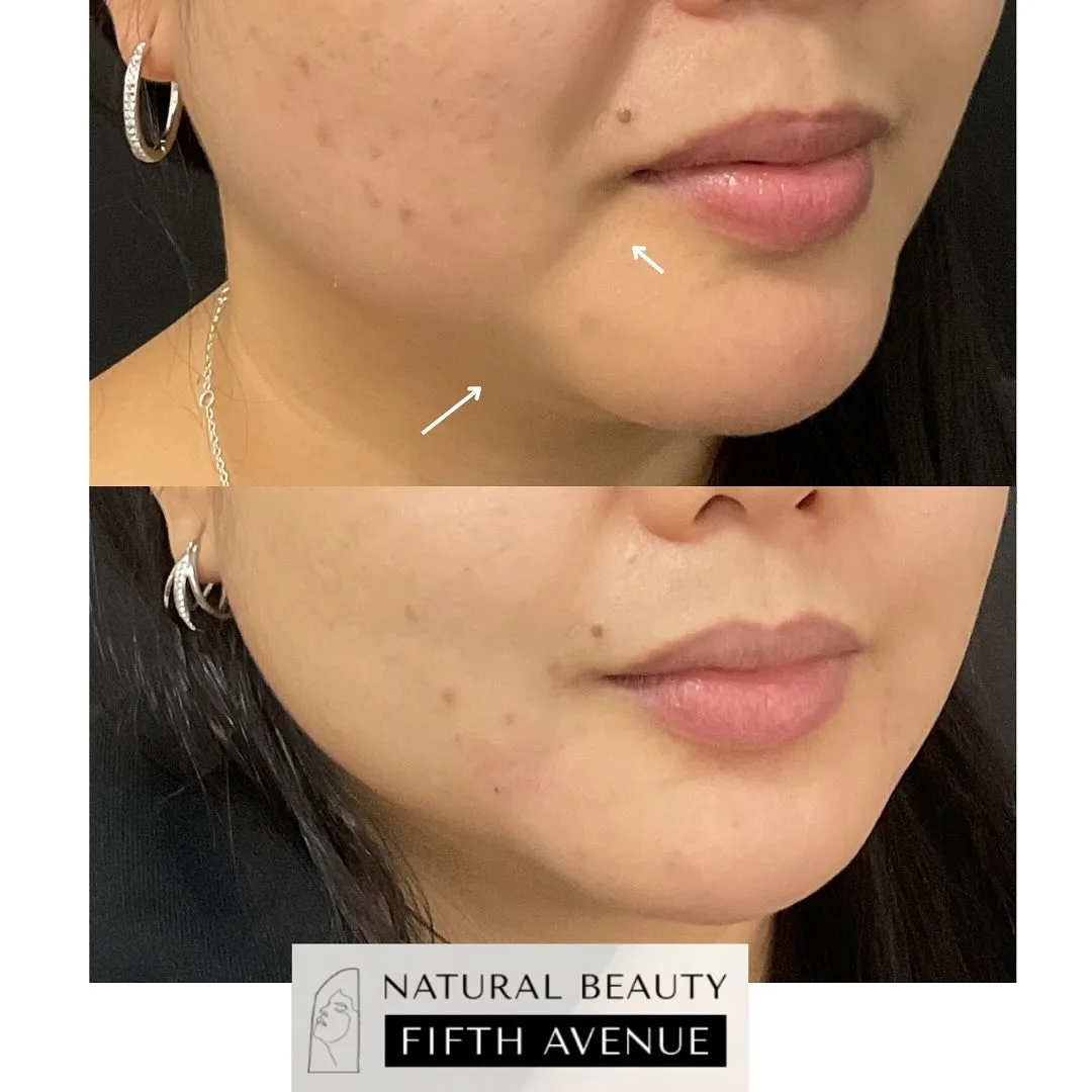 Hyaluronic Acid Fillers before and after