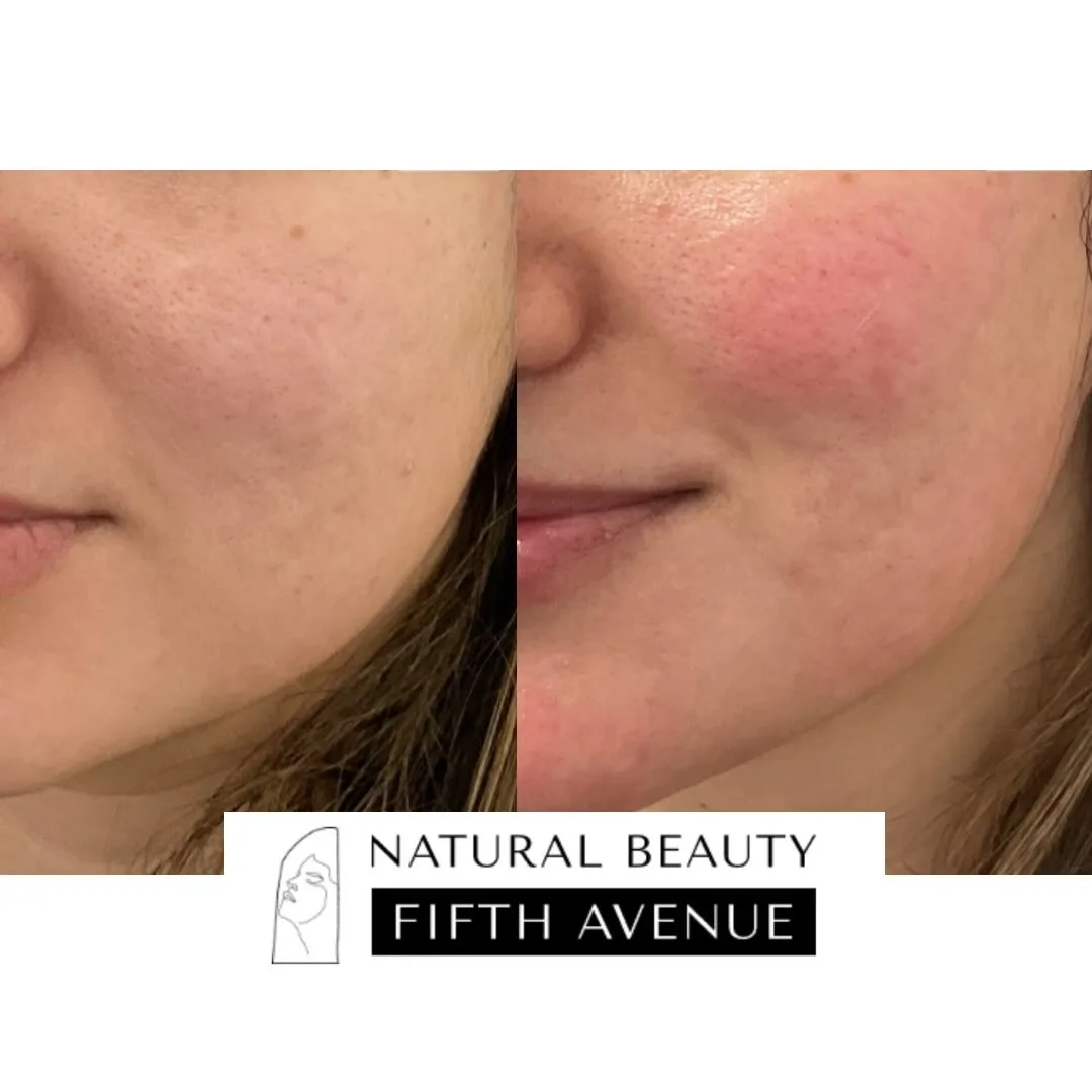 RF Microneedling + Subcision + Biostimulatory Injections before and after