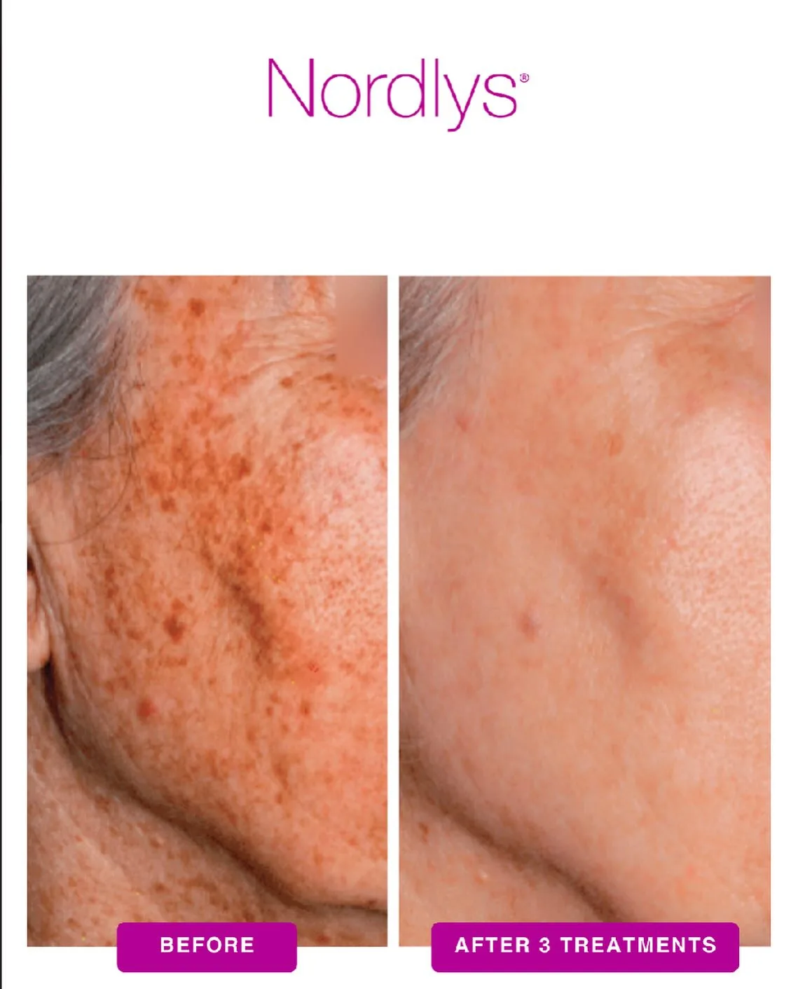 Nordlys SWT IPL Treatment before and after