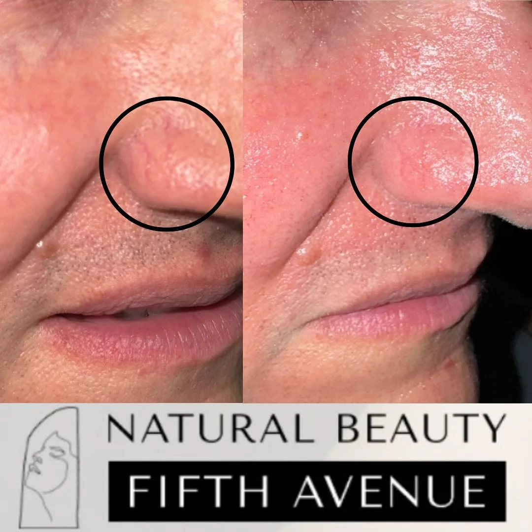 Rosacea Treatment before and after