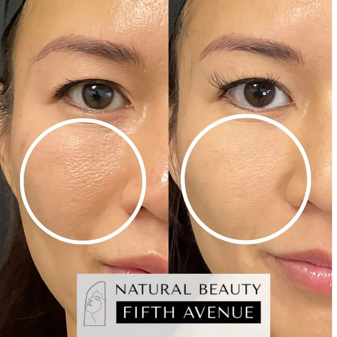 RF Microneedling Case 1 before and after at Natural Beauty NYC (4 of 4)