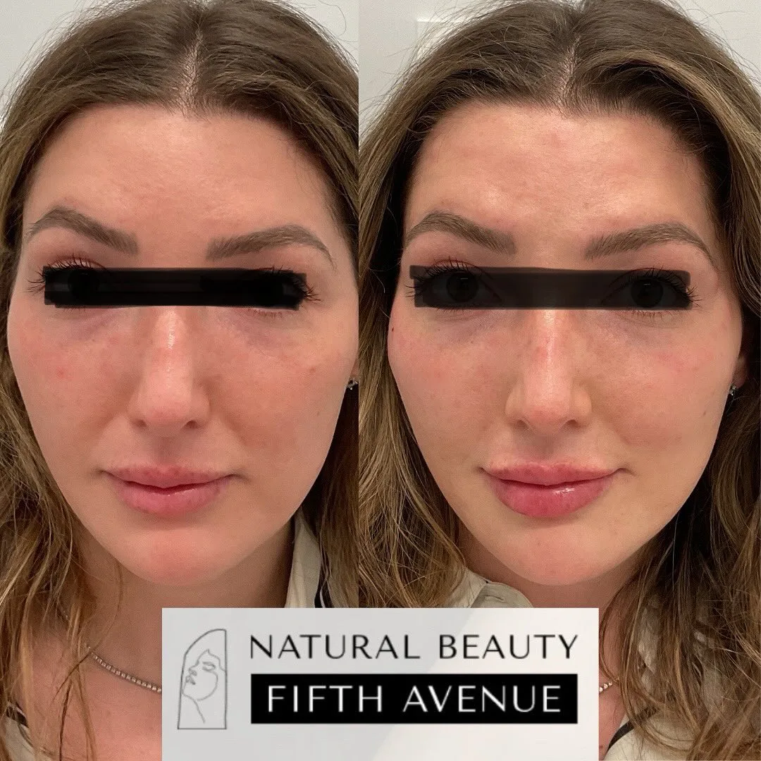 Dermal Fillers before and after at Natural Beauty NYC (3 of 3)