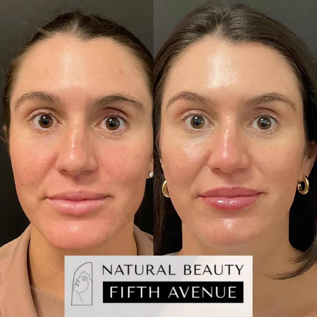 Skincare and Oral Medication before and after at Natural Beauty NYC (5 of 5)