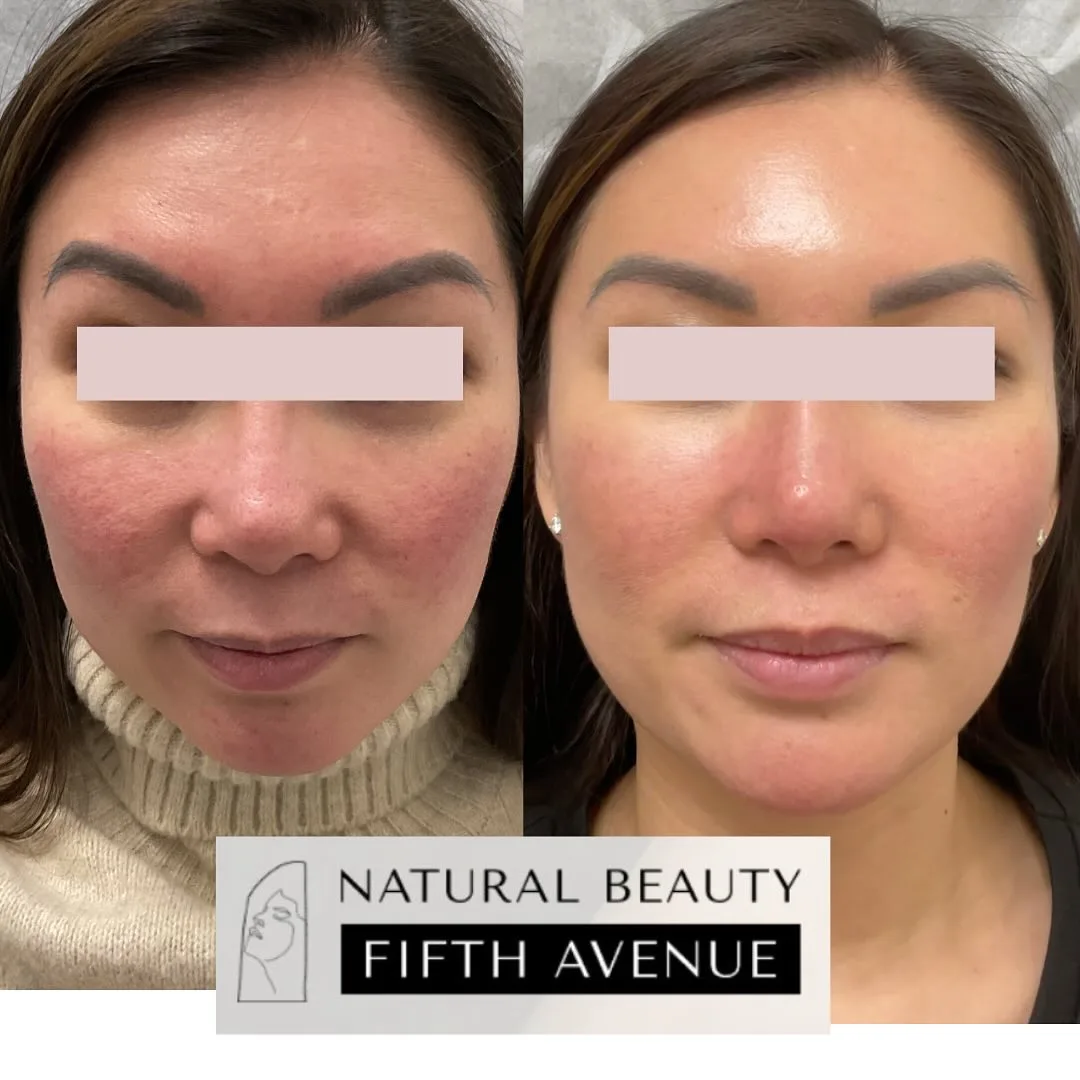 IPL Case 2 before and after at Natural Beauty NYC