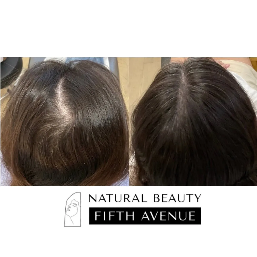 Hair Restoration - Case 1 before and after