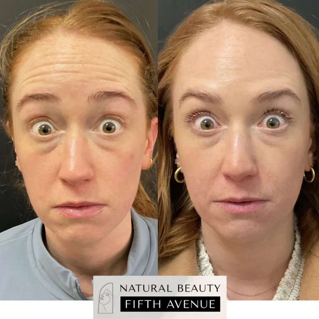 Brow Lift Case 1 before and after at Natural Beauty NYC