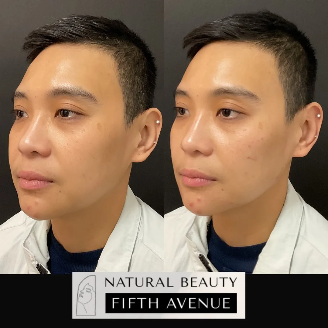 Dermal Filler Case 7 before and after at Natural Beauty NYC (4 of 4)