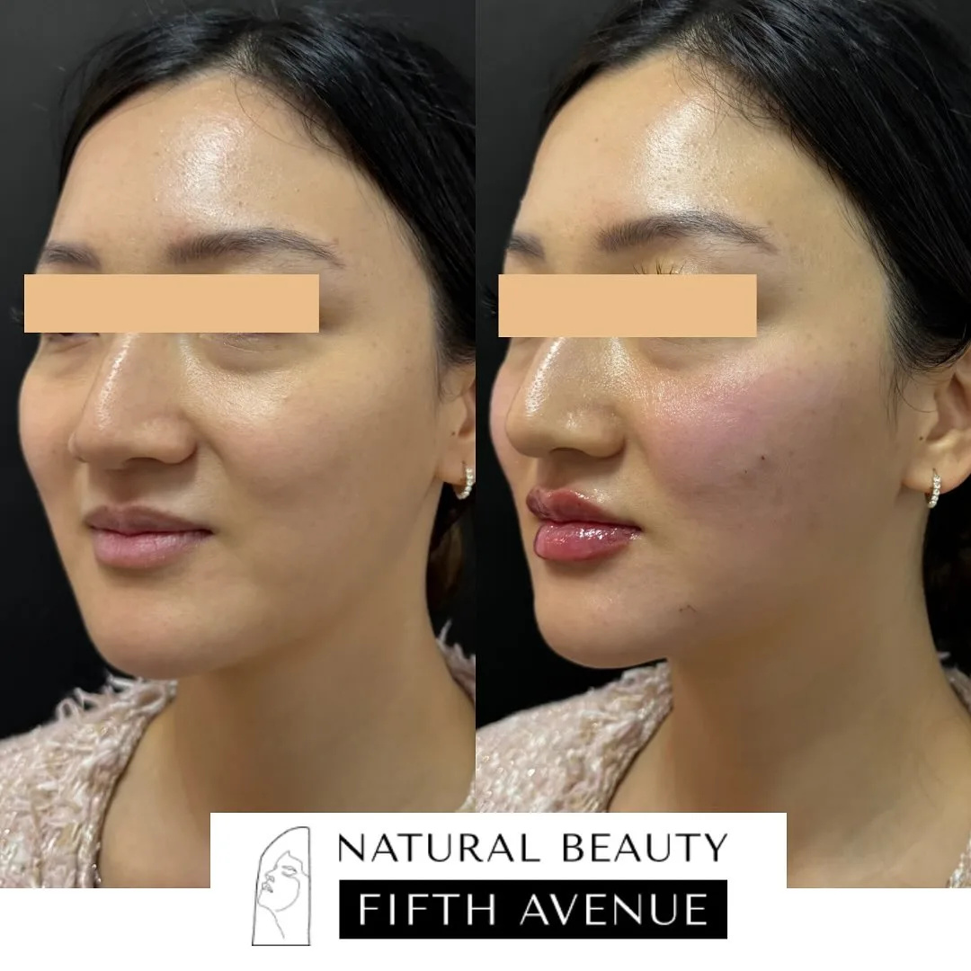 Dermal Fillers Case 4 before and after