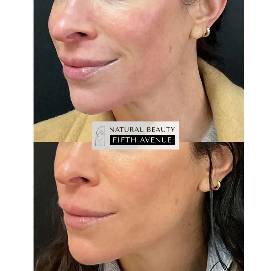 Rosacea Relief with IPL before and after