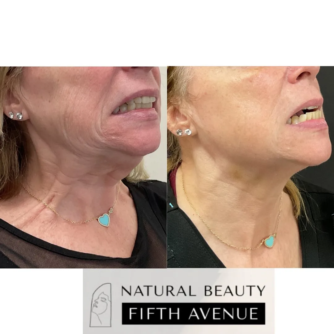 Nefertiti Lift Case 2 before and after at Natural Beauty NYC (4 of 4)