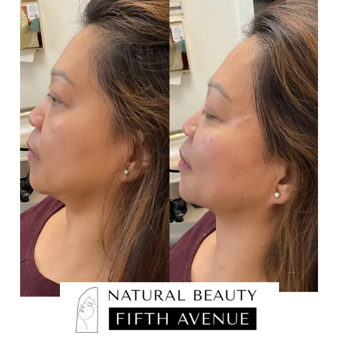 Radiesse Case 2 before and after at Natural Beauty NYC (4 of 4)