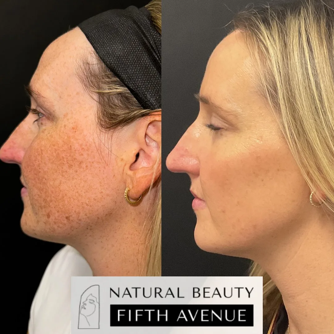 Skin Care after the procedure before and after at Natural Beauty NYC (4 of 5)
