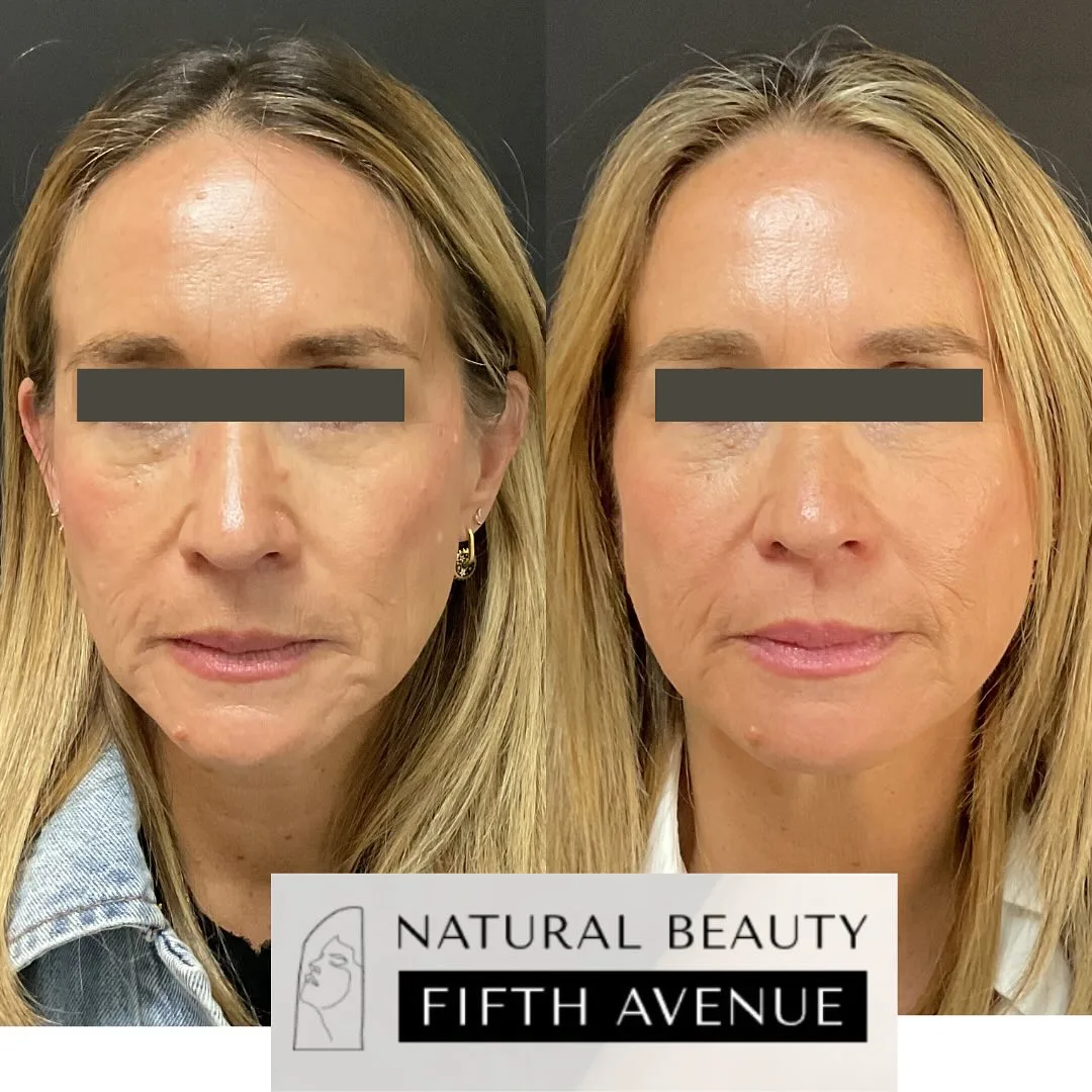 Sculptra Case 2 before and after at Natural Beauty NYC (2 of 2)