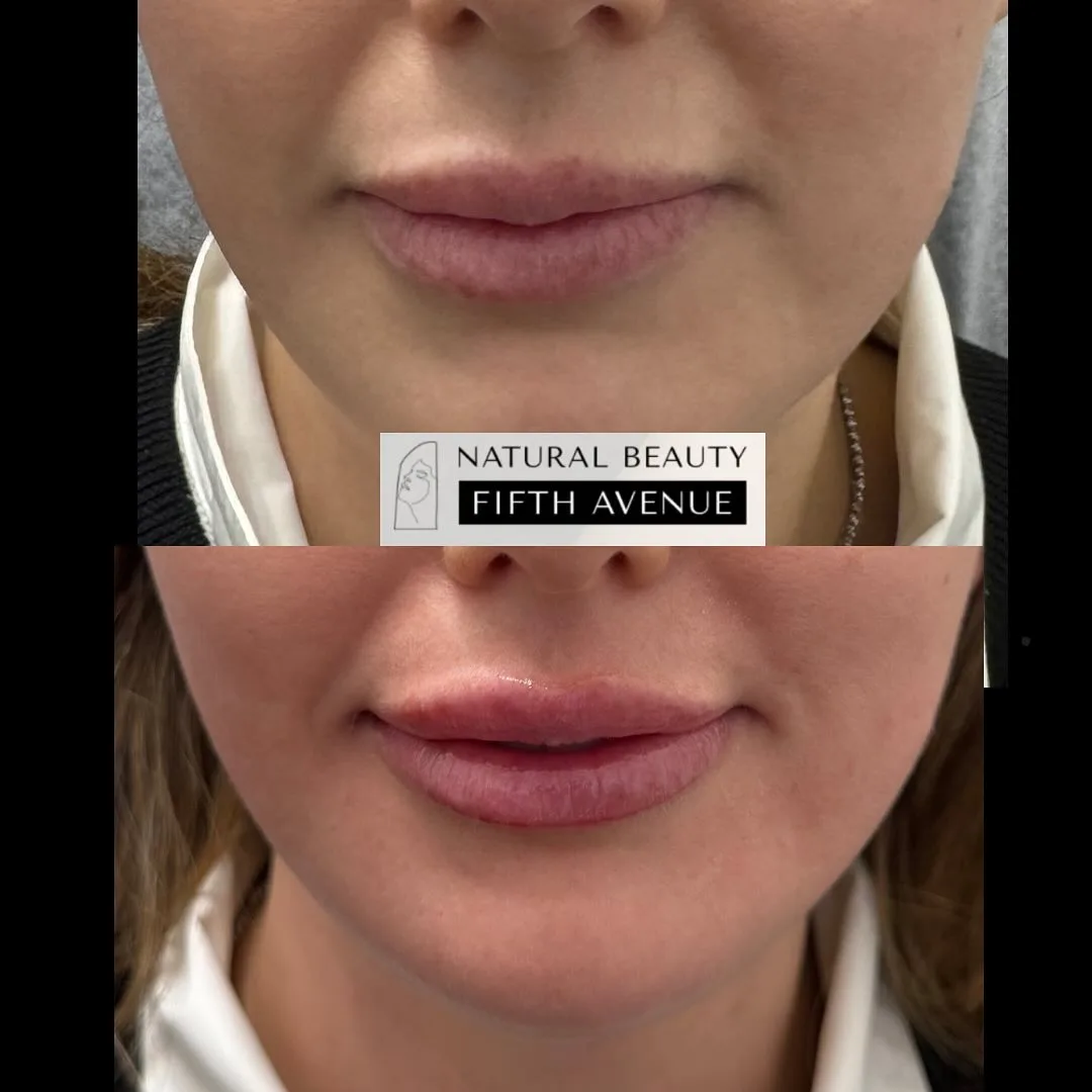 Lip Gloss Method before and after at Natural Beauty NYC (3 of 3)