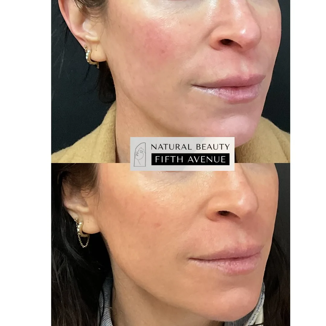 Rosacea Relief with IPL before and after at Natural Beauty NYC (3 of 3)