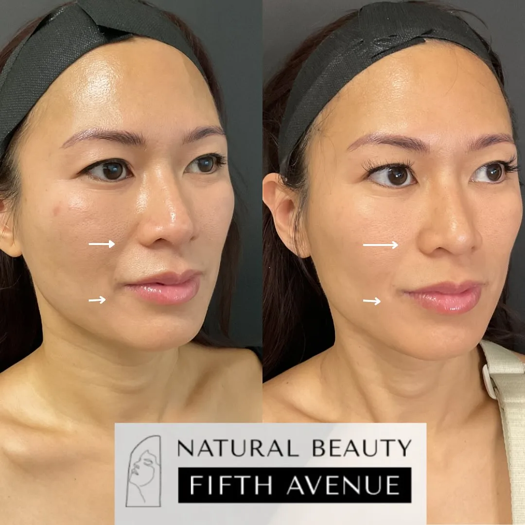RF Microneedling Case 1 before and after at Natural Beauty NYC