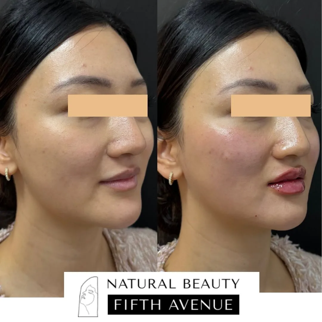 Dermal Fillers Case 4 before and after at Natural Beauty NYC (2 of 3)